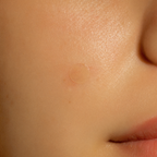 Lyviora® ClearPatch